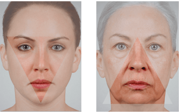 Full Facial Rejuvenation with Dermal Fillers