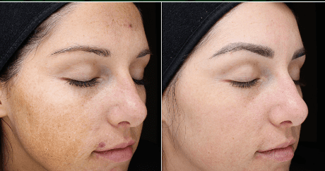 Before and after photo of a woman's face.